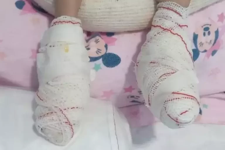 Bebê de 7 meses sofre queimaduras nos pés causadas por aquecedor ligado, em hospital de Jacareí